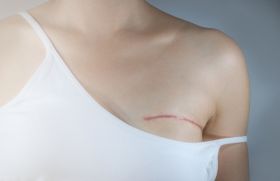 La mastectomie bilatérale